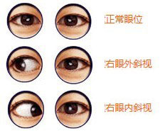 什么是斜视